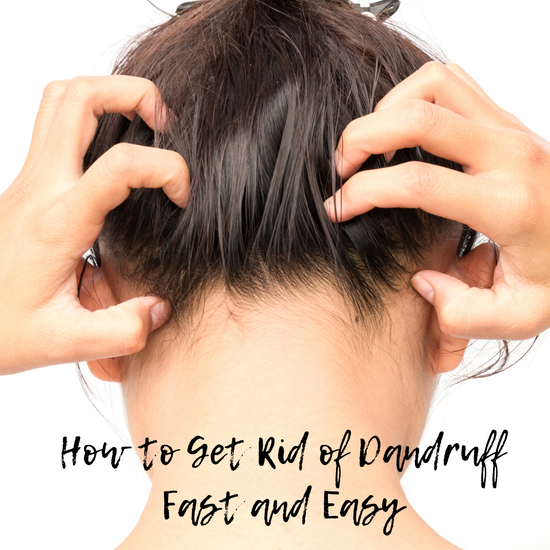 How to Get Rid of Dandruff Fast and Easy